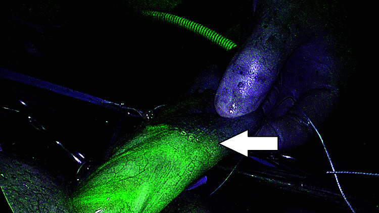 Mesenteric Vascular Evaluation with Pre-operative Multidetector Computed Tomographic Angiography and Intraoperative Indocyanine Green Angiography to Reduce Anastomotic Leaks after Minimally Invasive Surgery for Colorectal Cancer.