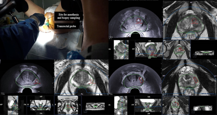 Lesion Volume in a Bi- or Multivariate Prediction Model for the Management of PI-RADS v2.1 Score 3 Category Lesions.