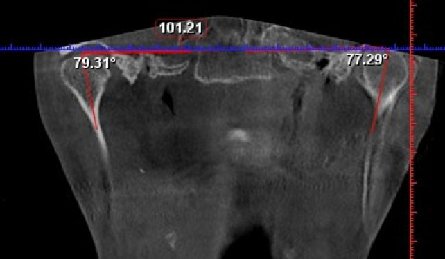 The Clinical and Radiographic Changes of Temporomandibular Joint (TMJ) Following Mandibular Set Back Surgery by Bilateral Sagittal Split Osteotomy (BSSO).