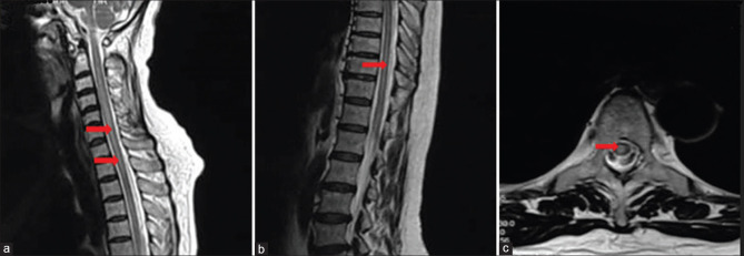 Longitudinally extensive transverse myelitis following ChAdOx1 nCoV-19 vaccine.