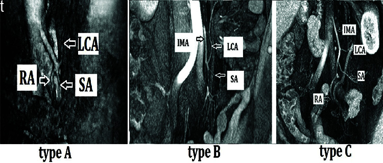 Mesenteric Vascular Evaluation with Pre-operative Multidetector Computed Tomographic Angiography and Intraoperative Indocyanine Green Angiography to Reduce Anastomotic Leaks after Minimally Invasive Surgery for Colorectal Cancer.