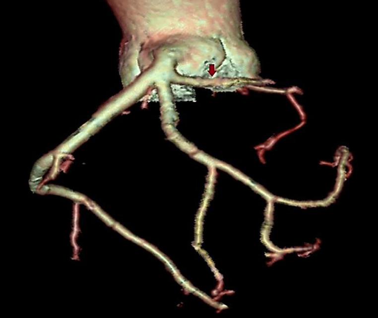 Unusual trifurcation of left main coronary artery in a patient with hypertrophic obstructive cardiomyopathy: Issues in management strategy.