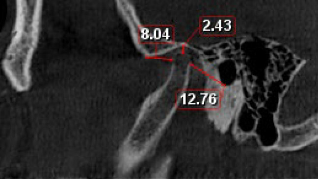 The Clinical and Radiographic Changes of Temporomandibular Joint (TMJ) Following Mandibular Set Back Surgery by Bilateral Sagittal Split Osteotomy (BSSO).