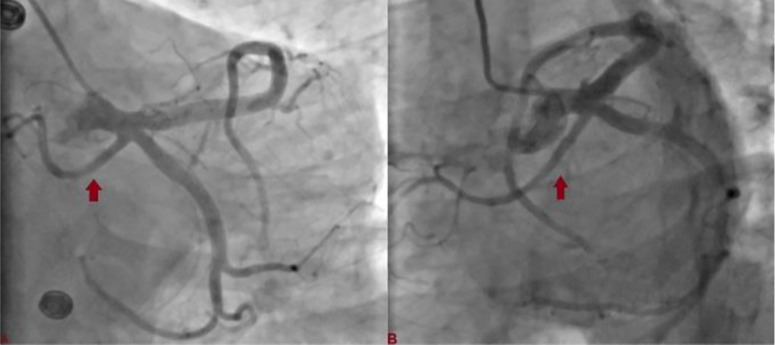 Unusual trifurcation of left main coronary artery in a patient with hypertrophic obstructive cardiomyopathy: Issues in management strategy.