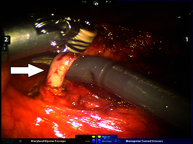 Mesenteric Vascular Evaluation with Pre-operative Multidetector Computed Tomographic Angiography and Intraoperative Indocyanine Green Angiography to Reduce Anastomotic Leaks after Minimally Invasive Surgery for Colorectal Cancer.