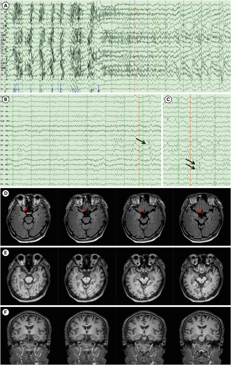 Transient Epileptic Amnesia With Amygdala Enlargement Presenting to a Dementia Clinic.