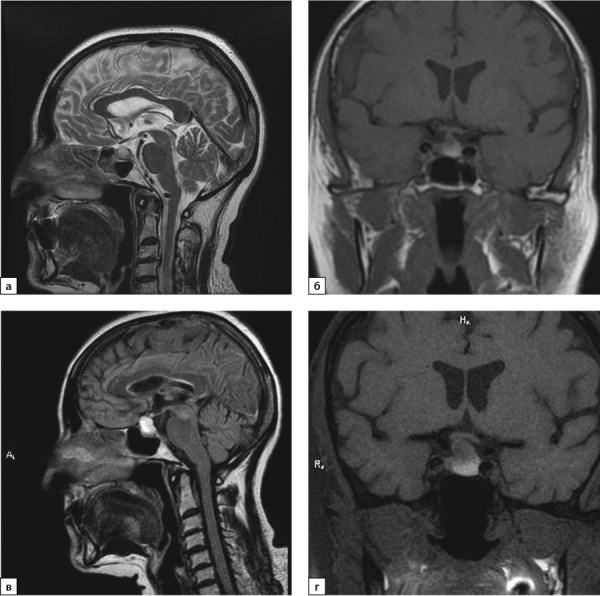 [Primary hypothyroidism and postmenopause as the causes of delayed diagnosis of panhypopituitarism in a patient with nonfunctional pituitary adenoma].