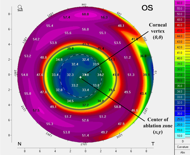 The influence of corneal ablation patterns on prediction error after cataract surgery in post-myopic-LASIK eyes.