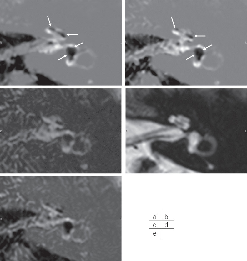 MR Imaging of Endolymphatic Hydrops in Five Minutes.