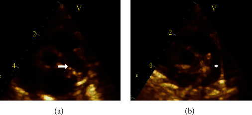Interruption of the Right Pulmonary Artery in a Neonate.