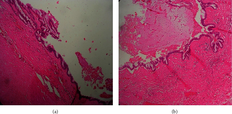 Sclero-Hyalinized Low-Grade Appendiceal Mucinous Neoplasm Clinically Mimicking an Ovarian Mass.