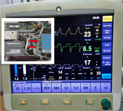 Spuriously low end tidal carbon dioxide in capnometry: Nafion tube malfunction in end tidal carbon dioxide module blamed for near mishap!