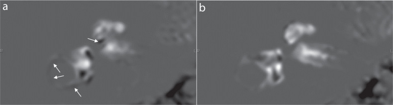 MR Imaging of Endolymphatic Hydrops in Five Minutes.