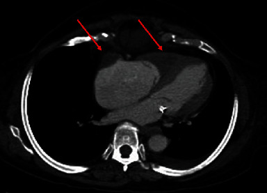 Eosinophilic Myocarditis: An Often-Overlooked Diagnosis in Patients Presenting with Heart Failure.