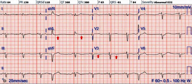 Eosinophilic Myocarditis: An Often-Overlooked Diagnosis in Patients Presenting with Heart Failure.