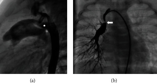 Interruption of the Right Pulmonary Artery in a Neonate.