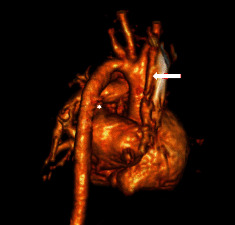 Interruption of the Right Pulmonary Artery in a Neonate.