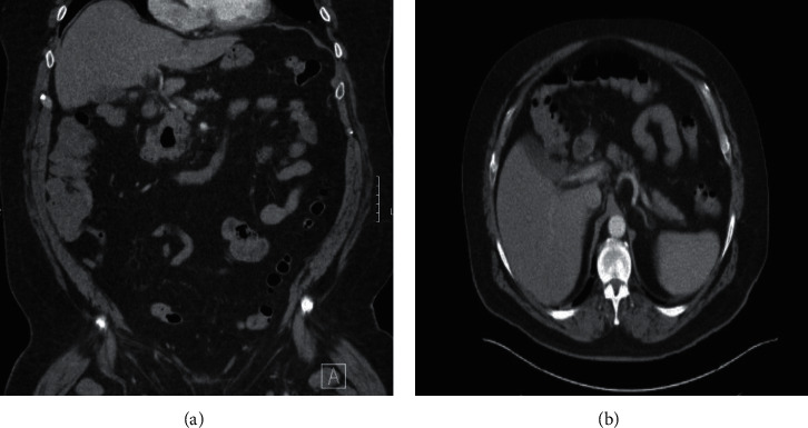 A Patient with SIADH, Urinary Retention, Constipation, and Bell's Palsy following a Tick Bite.