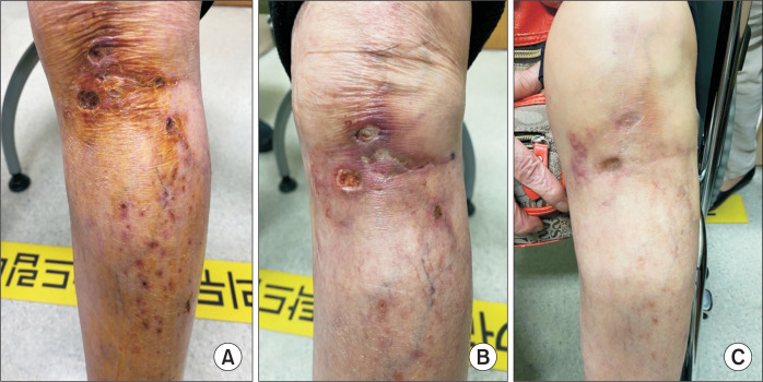 A Case of Superficial Thrombo-occlusive Vascular Disease in a Patient With Rheumatoid Arthritis.