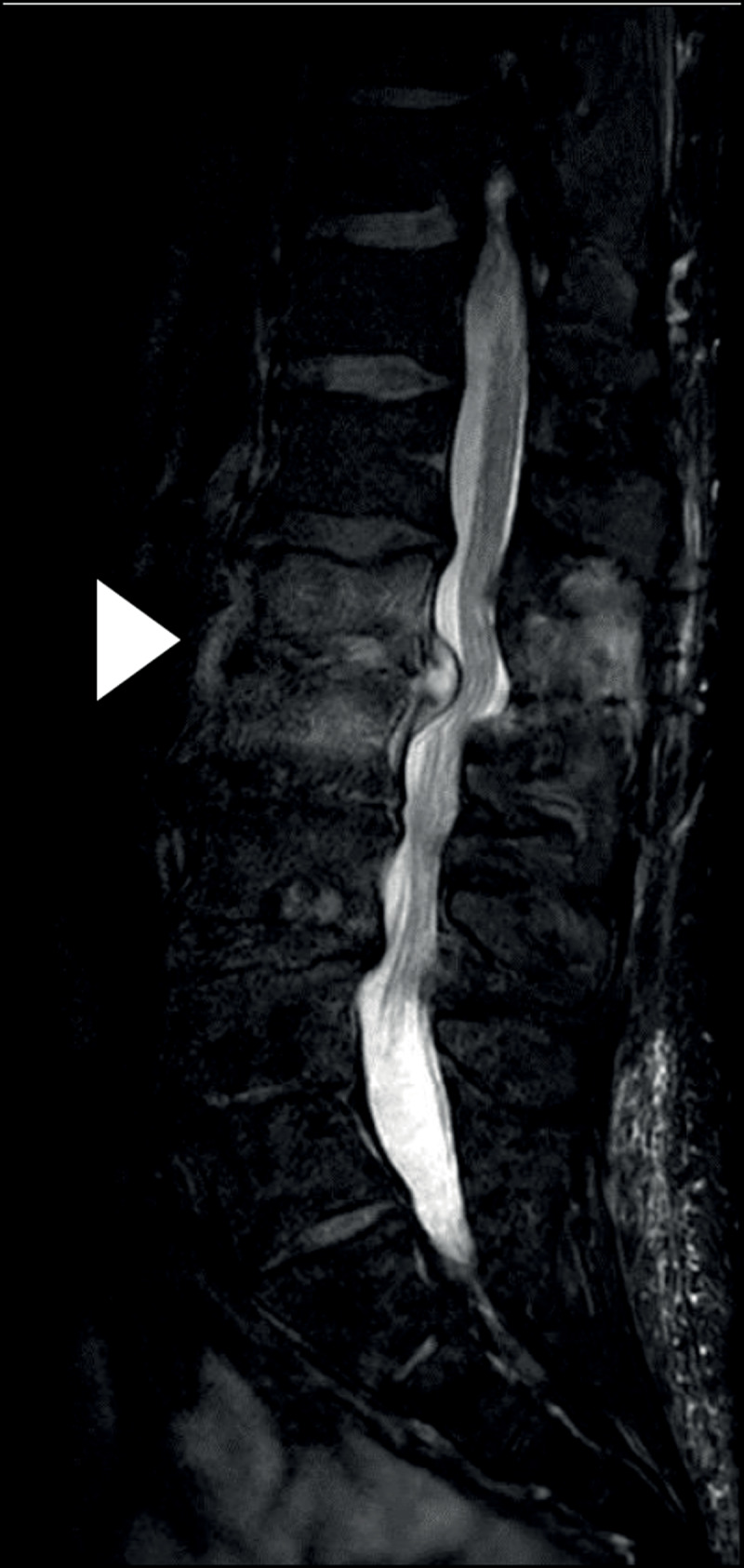 Mycobacterium Bovis Spondylodiscitis: A Rare Complication of Intravesical Bacillus Calmette-Guérin Therapy.