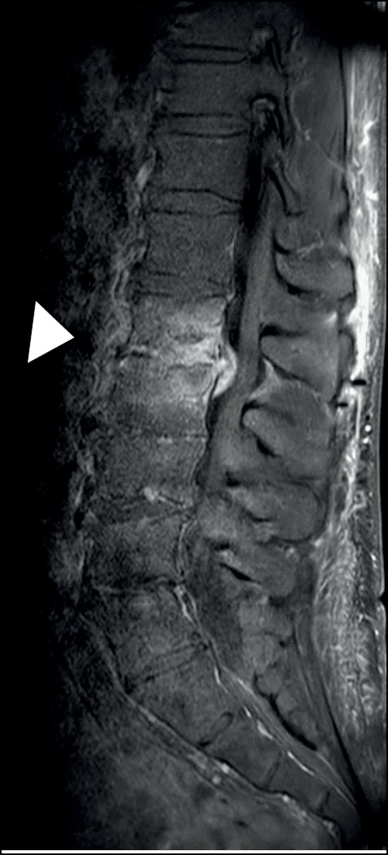 Mycobacterium Bovis Spondylodiscitis: A Rare Complication of Intravesical Bacillus Calmette-Guérin Therapy.