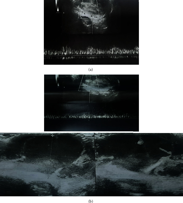 Necrotizing Epididymo-Orchitis: A Rare Manifestation of COVID-19.