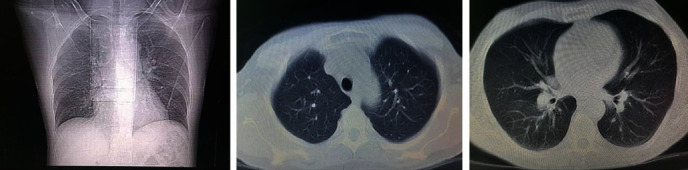 Necrotizing Epididymo-Orchitis: A Rare Manifestation of COVID-19.