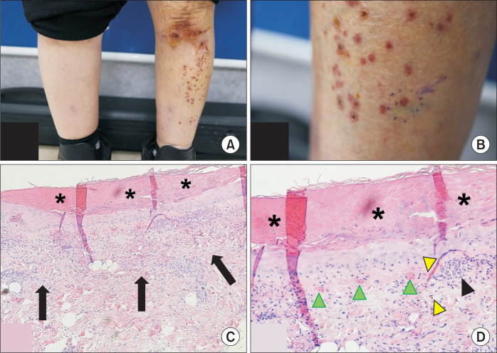 A Case of Superficial Thrombo-occlusive Vascular Disease in a Patient With Rheumatoid Arthritis.