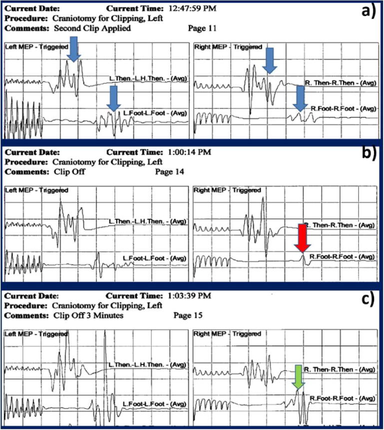 Utility of evoked potentials during anterior cerebral artery and anterior communicating artery aneurysm clipping