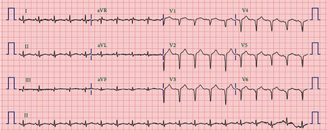 Ticagrelor-Induced Torsades de Pointes following Myocardial Infarction.