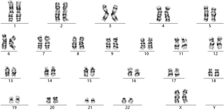 Prenatal diagnosis and genetic counseling of a paternally inherited chromosome 15q11.2 microdeletion in a Chinese family.