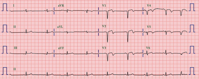 Ticagrelor-Induced Torsades de Pointes following Myocardial Infarction.
