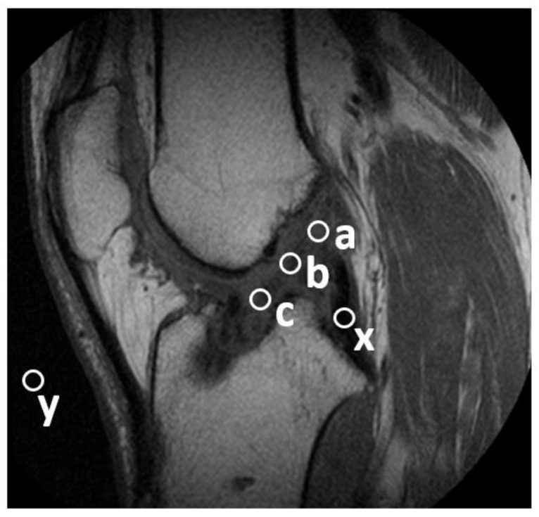 Effects of Platelet-Rich Osteoconductive-Osteoinductive Allograft Compound on Tunnel Widening of ACL Reconstruction: A Randomized Blind Analysis Study.