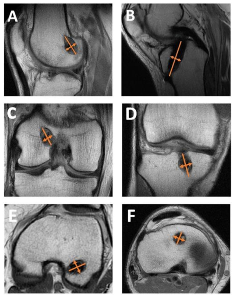 Effects of Platelet-Rich Osteoconductive-Osteoinductive Allograft Compound on Tunnel Widening of ACL Reconstruction: A Randomized Blind Analysis Study.