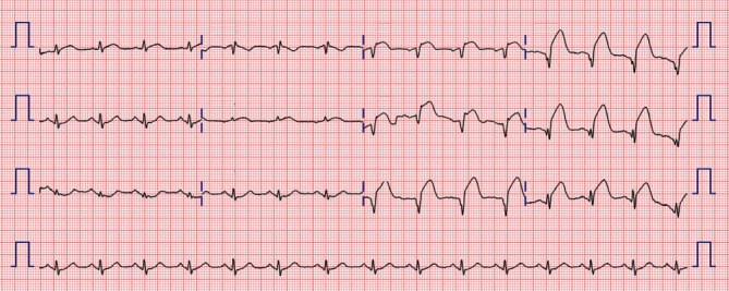 Ticagrelor-Induced Torsades de Pointes following Myocardial Infarction.