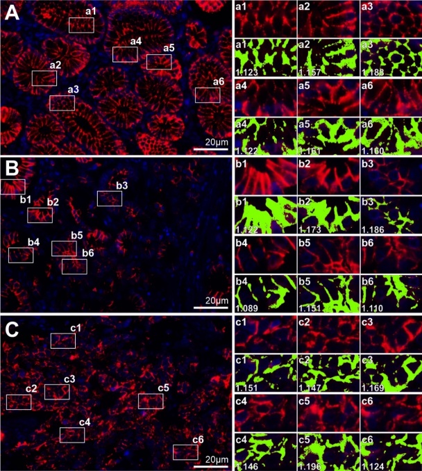 Subtle Immunoreactivity Differences in the Fractal Patterns of Membrane E-Cadherin in Gastric Adenocarcinoma.