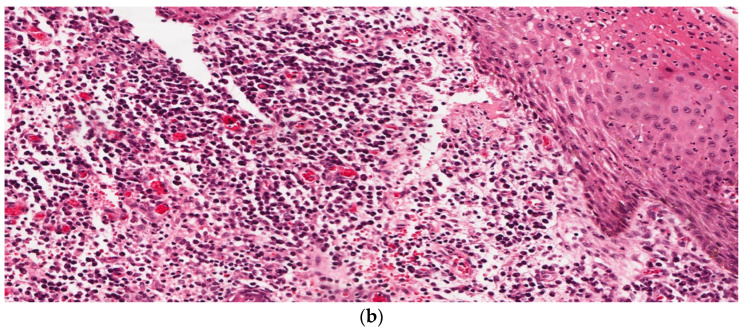Histopathology of Hidradenitis Suppurativa: A Systematic Review.