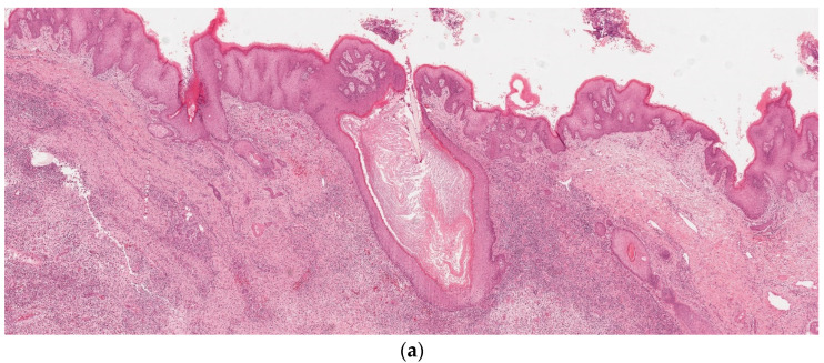 Histopathology of Hidradenitis Suppurativa: A Systematic Review.