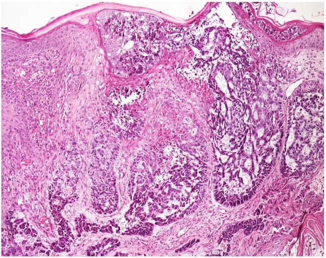 A Rare Case of Neglected Giant Basal Cell Carcinoma in a Nurse-Case Report and Literature Review.