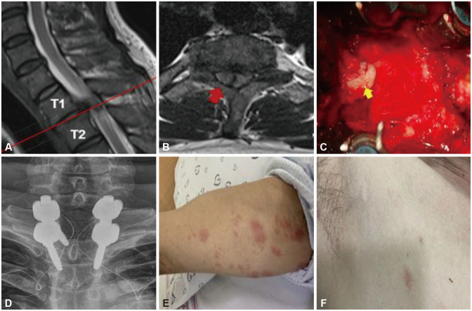 Herpes-Zoster-Mediated Radiculitis After Thoracic Spine Surgery.