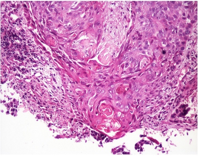 A Rare Case of Neglected Giant Basal Cell Carcinoma in a Nurse-Case Report and Literature Review.