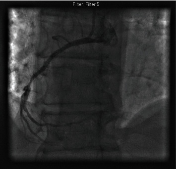 Intravascular Lithotripsy for Underexpanded Stent in Heavily Calcified Coronary Artery Disease.