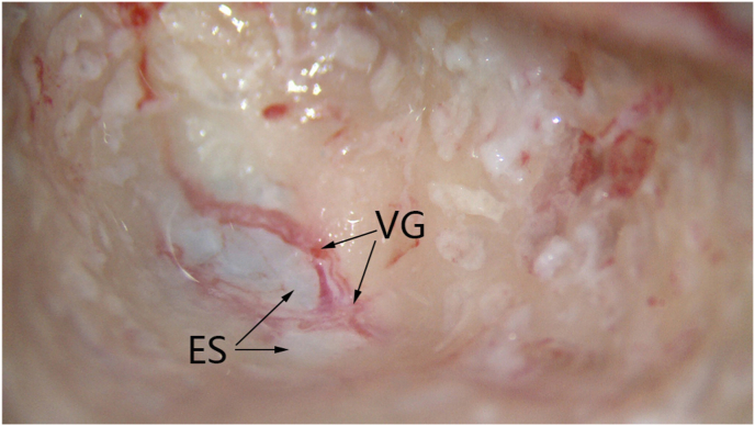 MEFV, IRF8, ADA, PEPD, and NBAS gene variants and elevated serum cytokines in a patient with unilateral sporadic Meniere's disease and vascular congestion over the endolymphatic sac