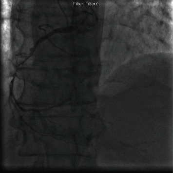Intravascular Lithotripsy for Underexpanded Stent in Heavily Calcified Coronary Artery Disease.