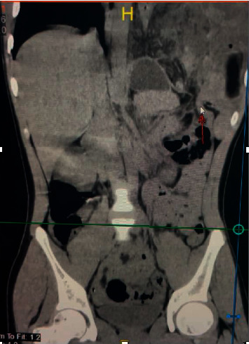 A Strangulated Congenital Diaphragmatic Bochdalek Hernia Diagnosed in an Adult.