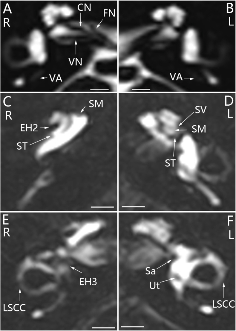 MEFV, IRF8, ADA, PEPD, and NBAS gene variants and elevated serum cytokines in a patient with unilateral sporadic Meniere's disease and vascular congestion over the endolymphatic sac