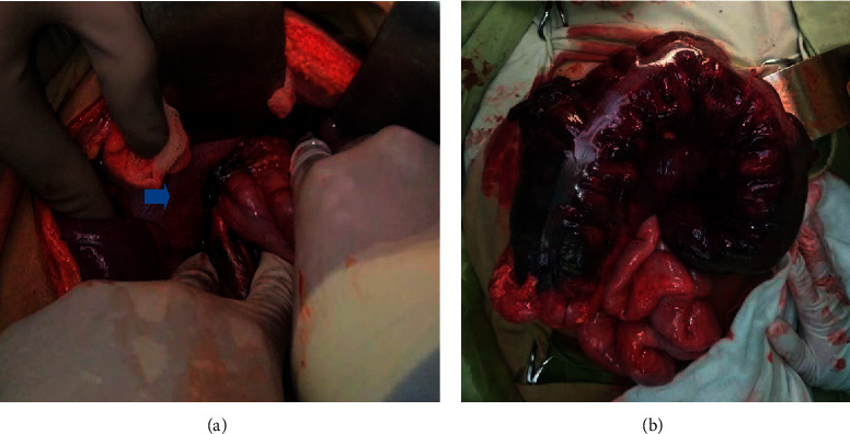 A Strangulated Congenital Diaphragmatic Bochdalek Hernia Diagnosed in an Adult.