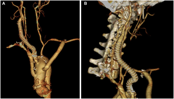 Single-stage repair for ascending aortic aneurysm, artery stenosis and occlusion of neck vessels caused by Takayasu arteritis.