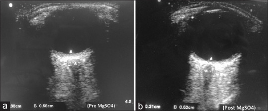 Ultrasonographic Changes in Transorbital Measurement of Optic Nerve Sheath Diameter in Magnesium Sulfate-Treated Severely Preeclamptic Patients: A Prospective Observational Study.