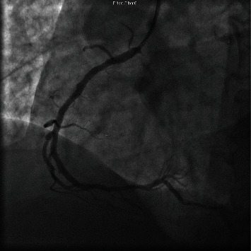 Intravascular Lithotripsy for Underexpanded Stent in Heavily Calcified Coronary Artery Disease.